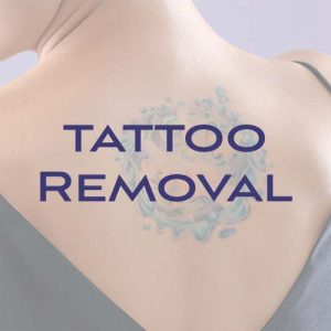Tattoo Removal Northern Kentucky