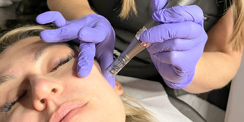 Microneedling on Patient at Zero Gravity in Cincinnati area Medical Spa.